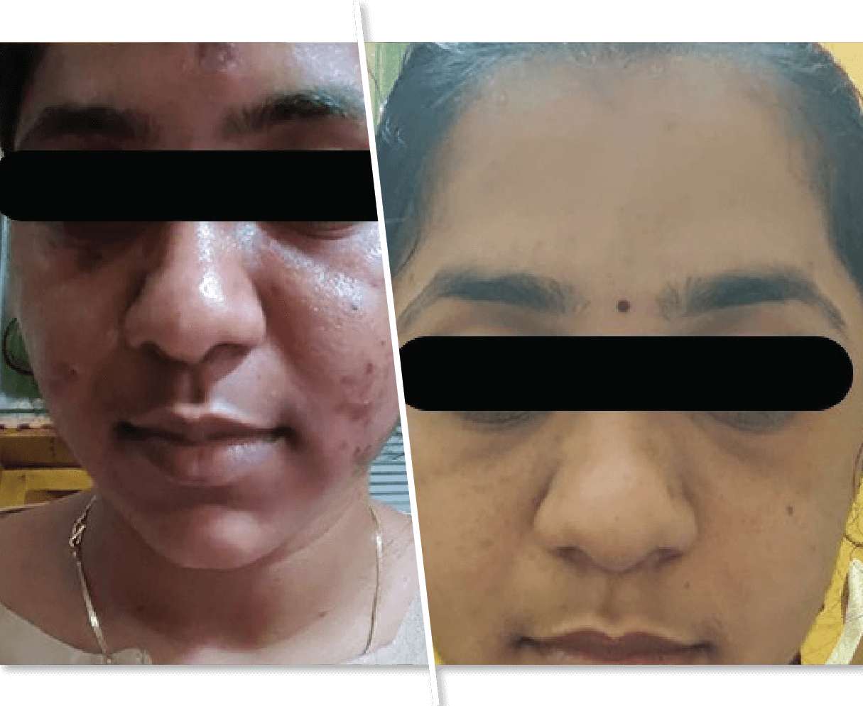 Skin Treatment Before and After Pictures
